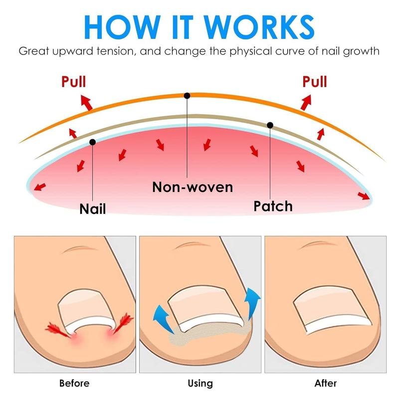 Breathable Ingrown Toenail Care Strip, 100pcs set Comfort Ingrown Toenail Sticker, Professional Pedicure for Ingrown Toenail